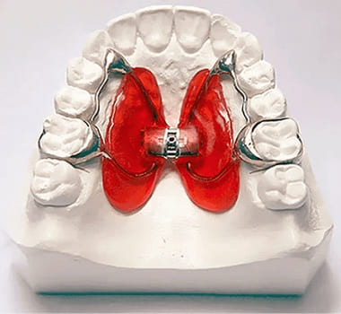 Аппараты для расширения челюсти