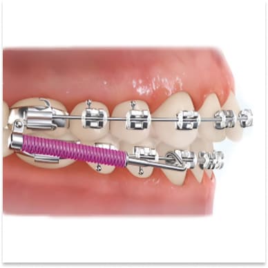 Корректоры II класса