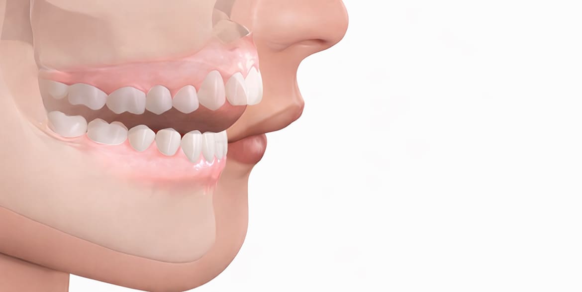 Почему не смыкаются зубы? Причины, диагностика и лечение открытого прикуса