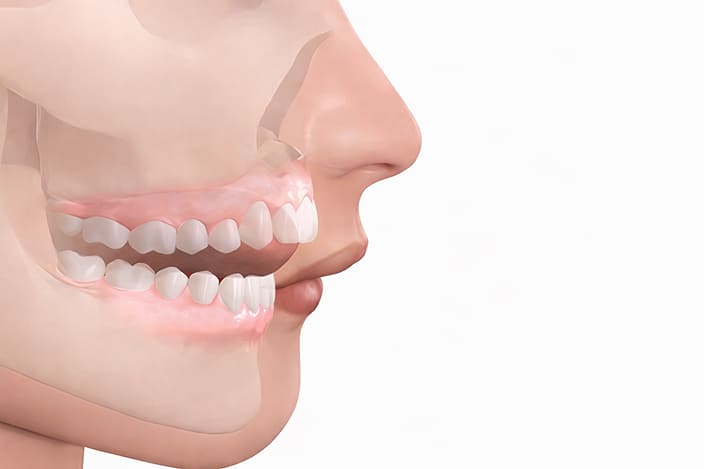 Почему не смыкаются зубы? Причины, диагностика и лечение открытого прикуса